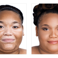 San Francisco's Mineral Cosmetic Studios - Vitiligo, Jane Iredale the Skin Care Makeup. Will cover.Products used: Amazing Base , and D2o hydration spray...