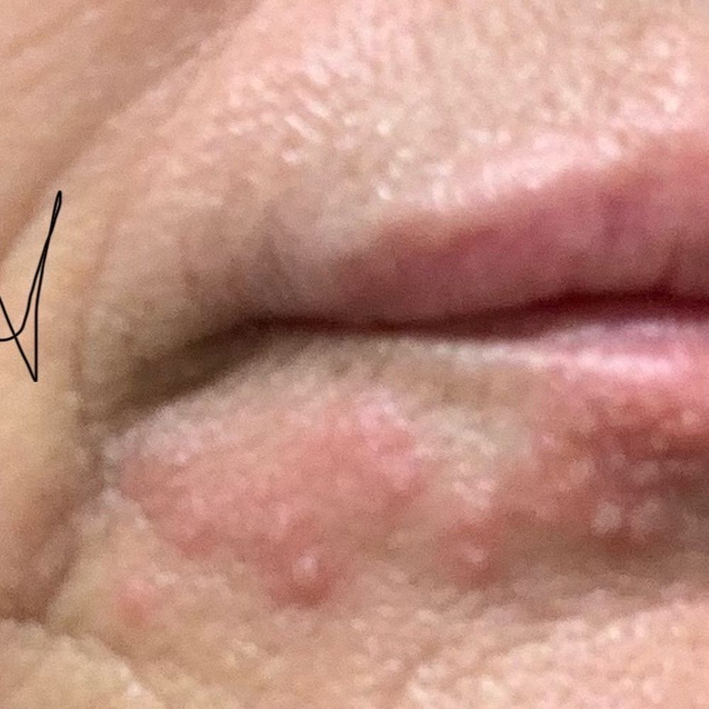 Luna Vision and Med Spa - Excess filler and lip trauma from injection. - Laser Eye Surgery/Lasik Near Me - Tarentum, Pennsylvania Luna Vision and Med Spa - Excess filler and lip trauma from injection. - Laser Eye Surgery/Lasik Near Me - Tarentum, Pennsylvania