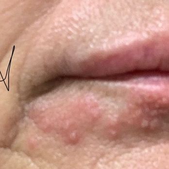 Luna Vision and Med Spa - Excess filler and lip trauma from injection. - Laser Eye Surgery/Lasik Near Me - Tarentum, Pennsylvania Luna Vision and Med Spa - Excess filler and lip trauma from injection. - Laser Eye Surgery/Lasik Near Me - Tarentum, Pennsylvania