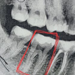 Cosmetic Micro Dentistry - Second photo. Her work. Filling extremely close to nerve