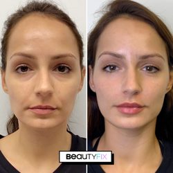 BeautyFix MedSpa - This BeautyFix consisted of Botox for her forehead lines, #EyeFix for dark circles & our #CheekFix for volume & projection. Refreshed!
