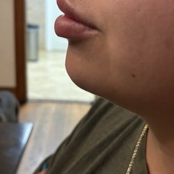 Smooch Beauty & Wellness - Lip filler