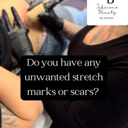Inkcious Beauty by Carmen - Did you know there is a non-invasive treatment that can help with unwanted stretch marks and scars?