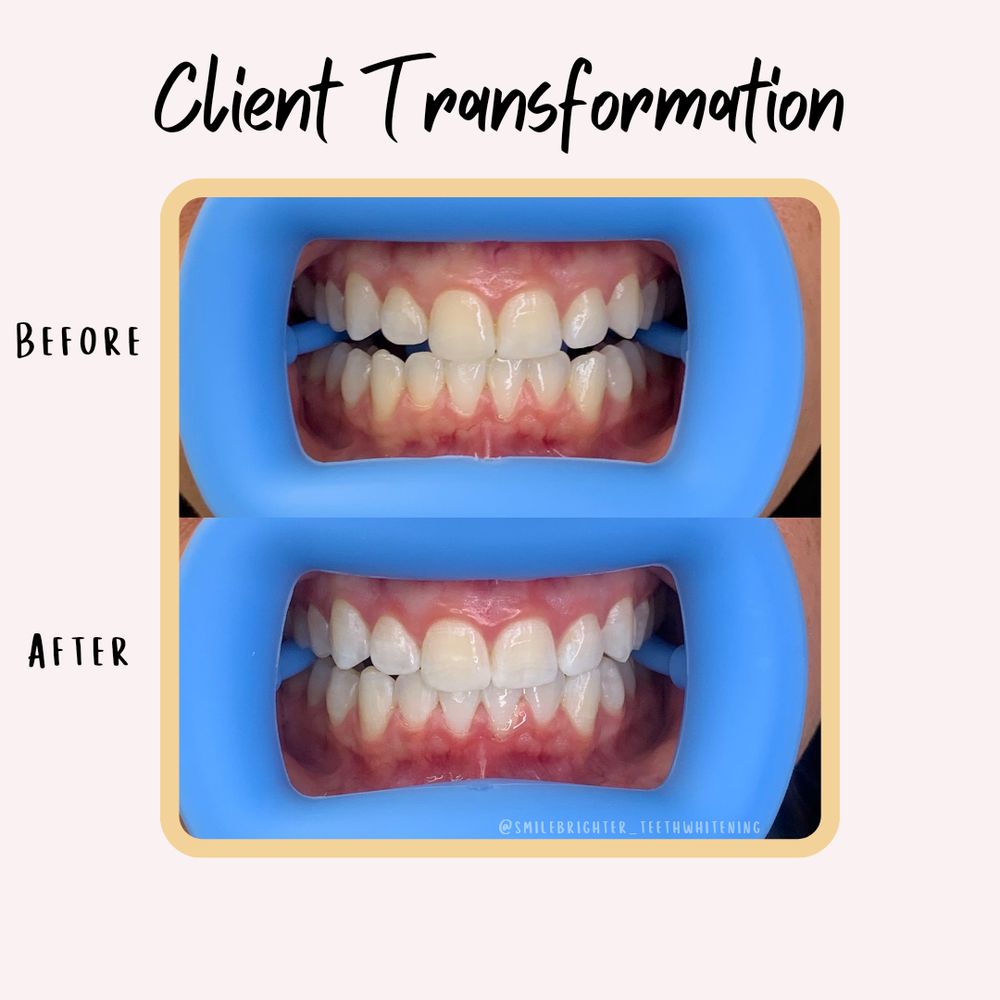 SMILE BRIGHTER TEETH WHITENING Updated April 2024 Request an