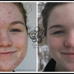 Adrianne Couvé Esthetics - Acne Client