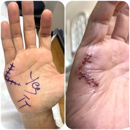 Hand surgery. Hand surgery.