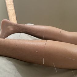 Acupuncture