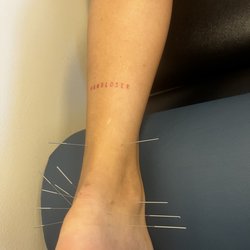 Camp interventional Pain Associates - Dry needling.