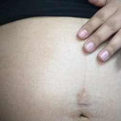 Camellia Women's Health - The scratch is next to my pointing finger going a vertical line