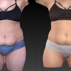 Ageless Sculpting and Wellness - 6 fat reduction sessions and 4 tightening sessions