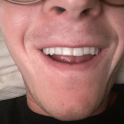 Peter VandenHoven - My shaved front tooth
