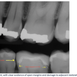 EZ Smile Family Dental Group - San Francisco - Open margin, and damage to adjacent restorations