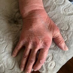 Labcorp - The swollen hand of my mom after they pinched a nerve