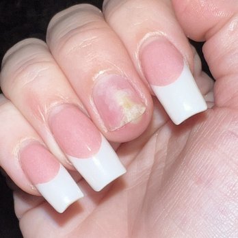 Avalon Nails - My infected nail - Nail Salons Near Me - Garland, Texas Avalon Nails - My infected nail - Nail Salons Near Me - Garland, Texas