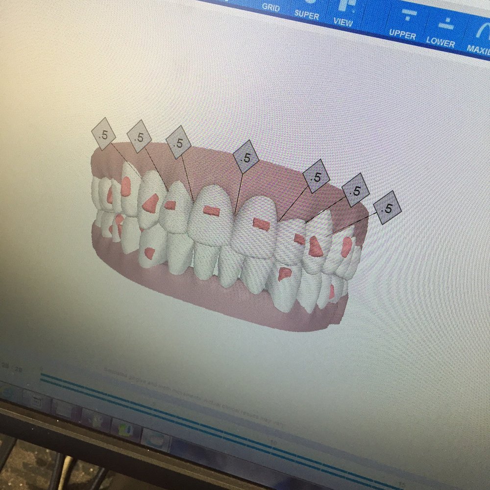 Santelli Orthodontics - If all goes as planned your Invisalign will move your teeth as shown. - Orthodontists Near Me - Boca Raton, Florida Santelli Orthodontics - If all goes as planned your Invisalign will move your teeth as shown. - Orthodontists Near Me - Boca Raton, Florida