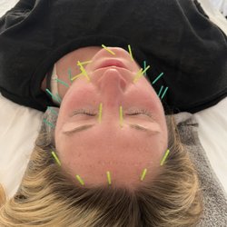 The Acu Facial