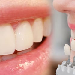 Matthew Pavlovich, DDS - Pavlovich Dental also offers Veneers & Lumineers.