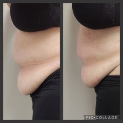 Body Secrets - Breaking down fat with cavitation!