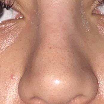 Vladimir Grigoryants, MD - As you can see, the bumps on the bottom sides of my nose, also an undefined bridge??? Idk but all I know is I am very unsatisfied - Cosmetic Surgeons Near Me - Glendale, California Vladimir Grigoryants, MD - As you can see, the bumps on the bottom sides of my nose, also an undefined bridge??? Idk but all I know is I am very unsatisfied - Cosmetic Surgeons Near Me - Glendale, California