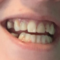 Steel City Dental - Front left tooth was shaved diagonally at left corner without addressing it with me or attempting to correct the assistant Kenya