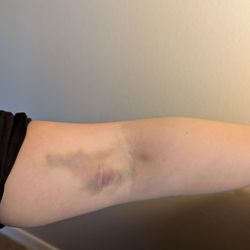 BioLife Plasma Services - Hematoma I sustained