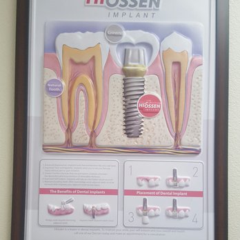 Smilesavers Dental - GET A FREE IMPLANT CONSULTATION - General Dentistry Near Me - Sunnyvale, California Smilesavers Dental - GET A FREE IMPLANT CONSULTATION - General Dentistry Near Me - Sunnyvale, California