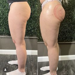 Beauty & Class Salon/Body Contouring - 3 sessions of the vacuum buttlift