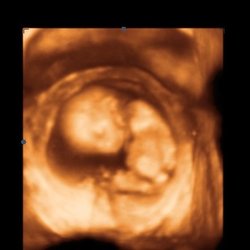 Peekme 3D/4D Ultrasounds