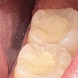 Newport Beach Dentistry - Teeth fillings (cavaties were really deep in these)