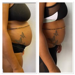 Black Lotus Spa - Results after 3 sessions of cryotherapy with the Cryo Tshock