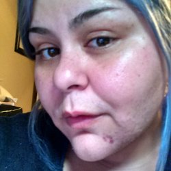 Electrolysis - Busted capillary and swelling.