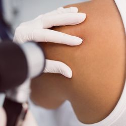 Rustad Dermatology, PC - skin-cancer-check-up
