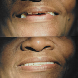 Jack Shabanian, DDS - Actual before and after photo