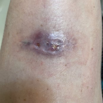 Advanced Dermatology - After 10 weeks and seeing a different specialist just starting to close... - Dermatologists Near Me - Lincolnshire, Illinois