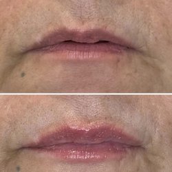 Infinite Wellness Med Spa - Before and After