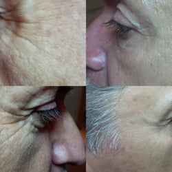 The Skin Klinic - Eye Treatment with Dermasound after 1 treatment