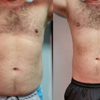 Lite Body Sculpting - Men LOVE the body sculpting treatments too! - Weight Loss Centers Near Me - Citrus Heights, California