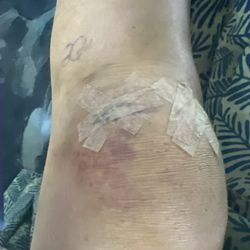 American Fork Hospital - Knee recovery