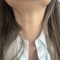 Michael Mosher, MD - This is 1 day after my testing and medication he provided (: