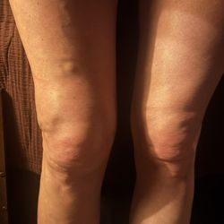 Nashville Knee & Shoulder Center - Feeling awesome in shorts , NOT