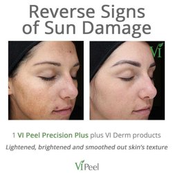 Skin Within - Vi Peel and Derm