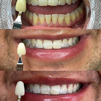Bella Nova Teeth Whitening - Client's amazing results after 2 sessions. - Teeth Whitening Near Me Bella Nova Teeth Whitening - Client's amazing results after 2 sessions. - Teeth Whitening Near Me