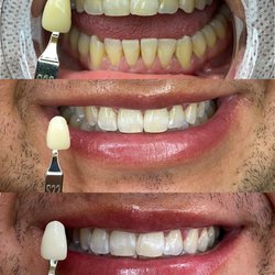 Bella Nova Teeth Whitening - Client's amazing results after 2 sessions.