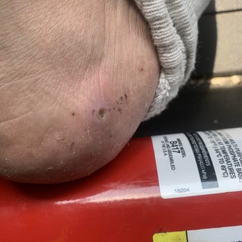 Stylish Nails - Infected due to nasty dirty tools during pedicure - Nail Salons Near Me - Highland, California Stylish Nails - Infected due to nasty dirty tools during pedicure - Nail Salons Near Me - Highland, California