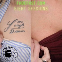 Fade Fast Tattoo Removal