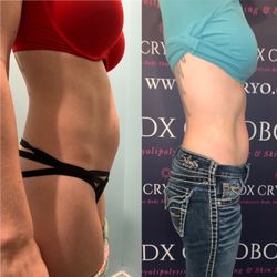 PDX CryoBody - Tummy tuck after 3 sessions