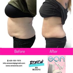 Renew ND Medspa - EON robotic body contouring and Semaglutide combo treatment.