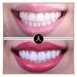 Calabasas Smiles - Smile Makeover