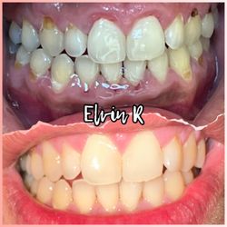 Igor Ochev, DDS - EvoSmile - Gum disease, acid erosion from what dr ochev explained to me and cavities. MY BEFORE AND AFTER