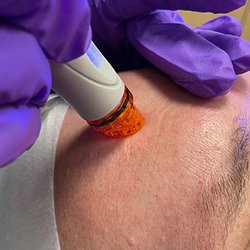 Extract, Hydrate and Cleanse with Hydrafacial